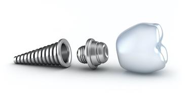 dental implant charlotte nc