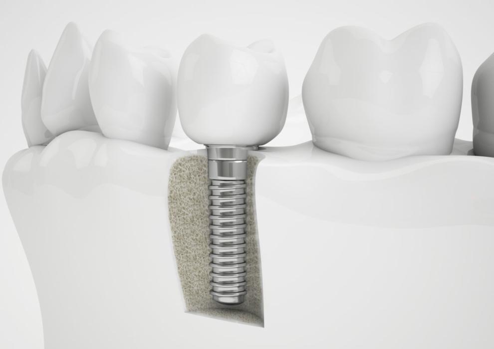 dental implants graphic in charlotte nc 