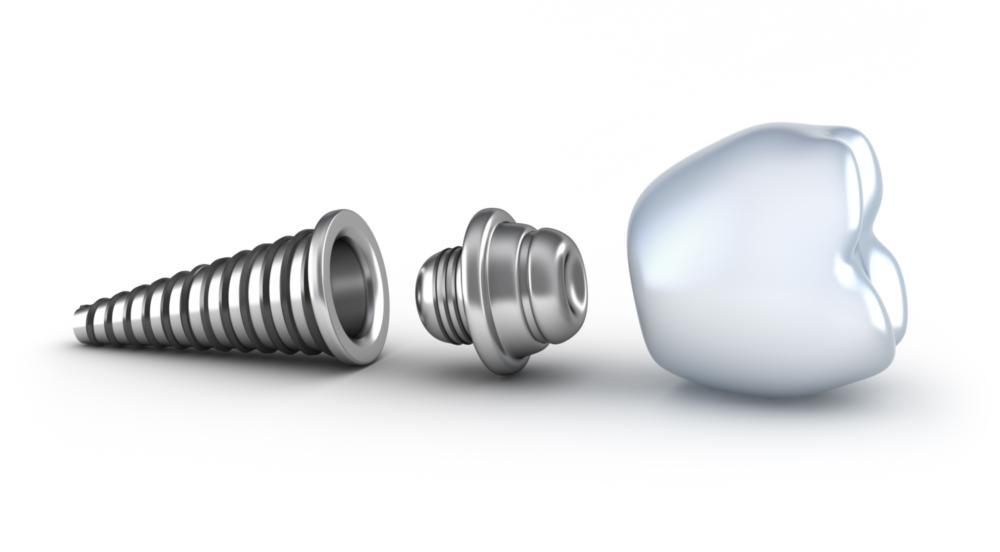 image of an animated dental implant