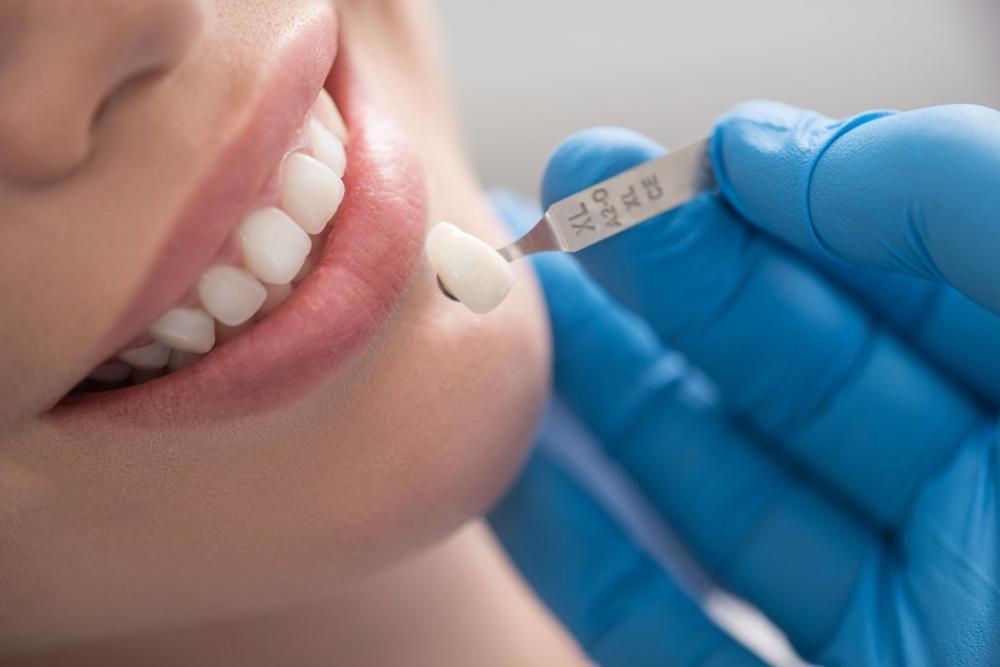 woman with porcelain veneers in charlotte nc 