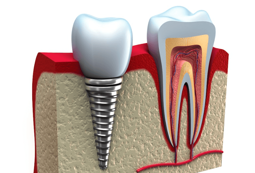 Dental Implant Care Guide Dental Implants Charlotte NC