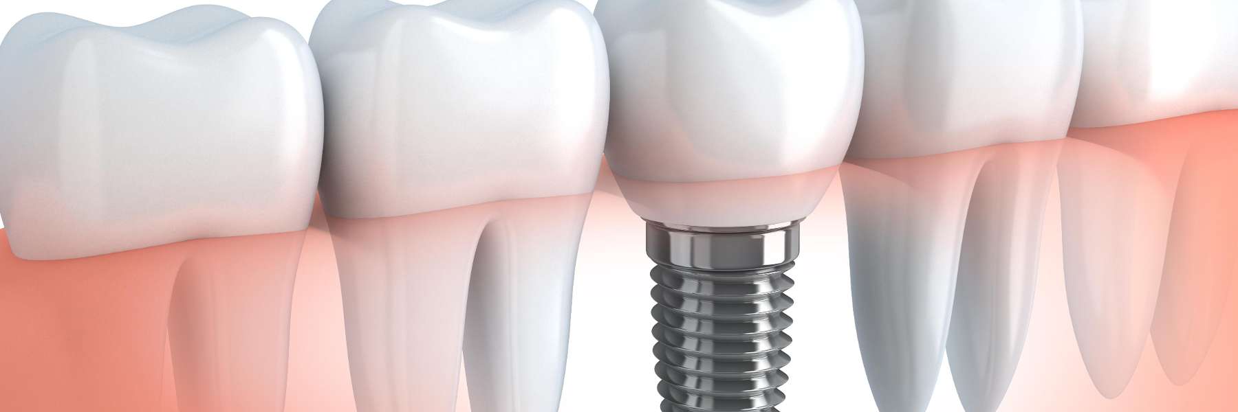 Dental Implants - Harlow Dental, charlotte nc
