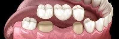 image of a dental bridge in charlotte nc