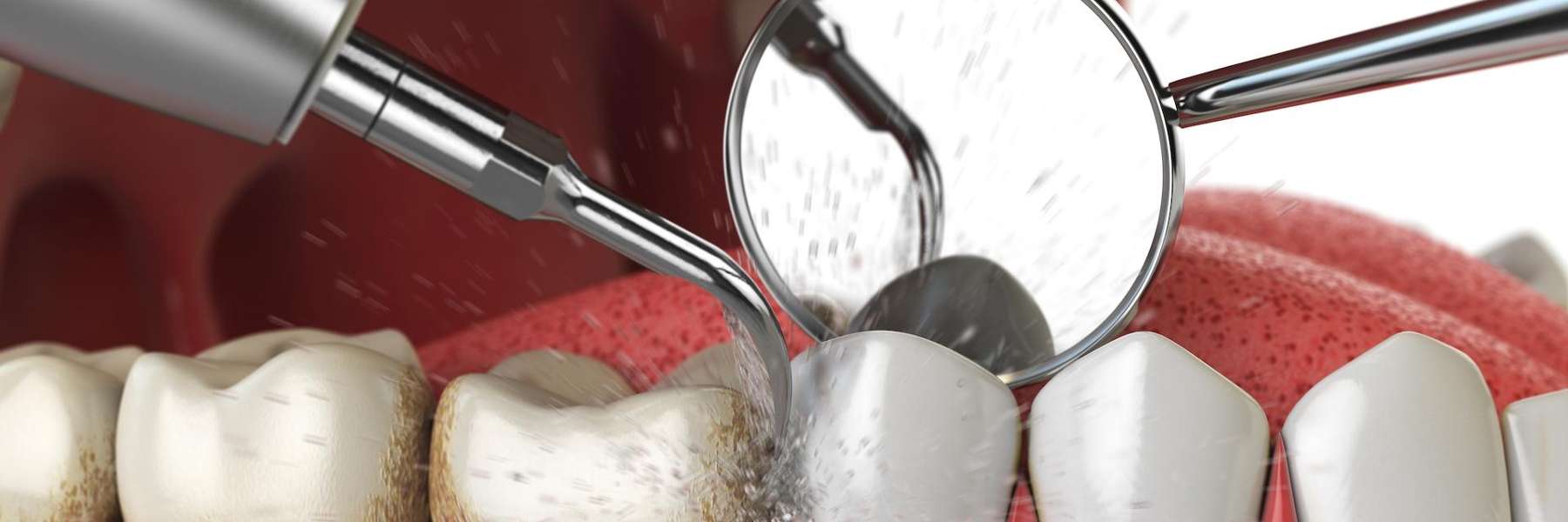 close up of dental tools in mouth | dentist charlotte nc