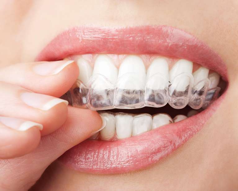 Invisalign aligner being put into a mouth, charlotte nc