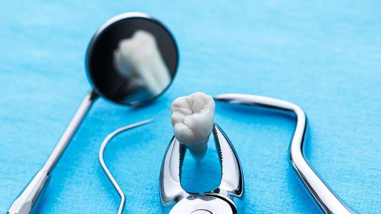 close up of extracted tooth | dental extractions charlotte nc
