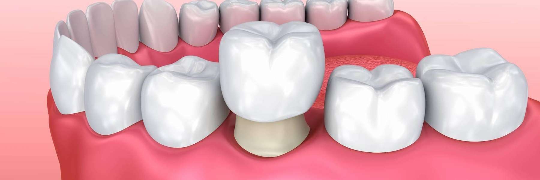Fixed Dental Prosthesis