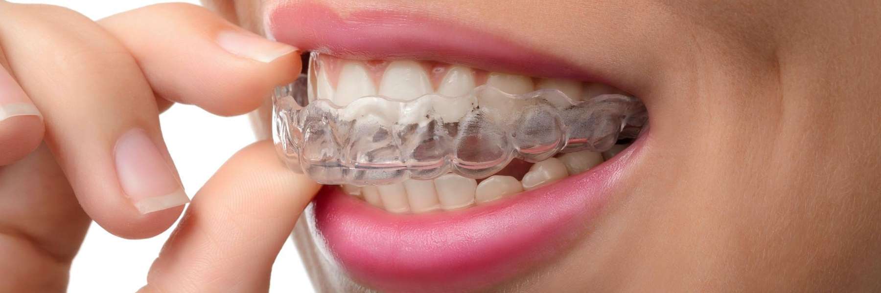 Invisible Braces