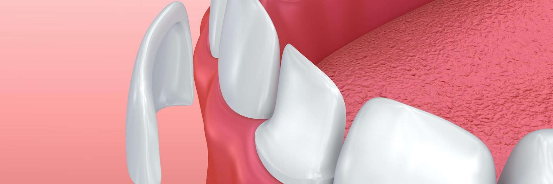Veneer being placed on a tooth, charlotte nc