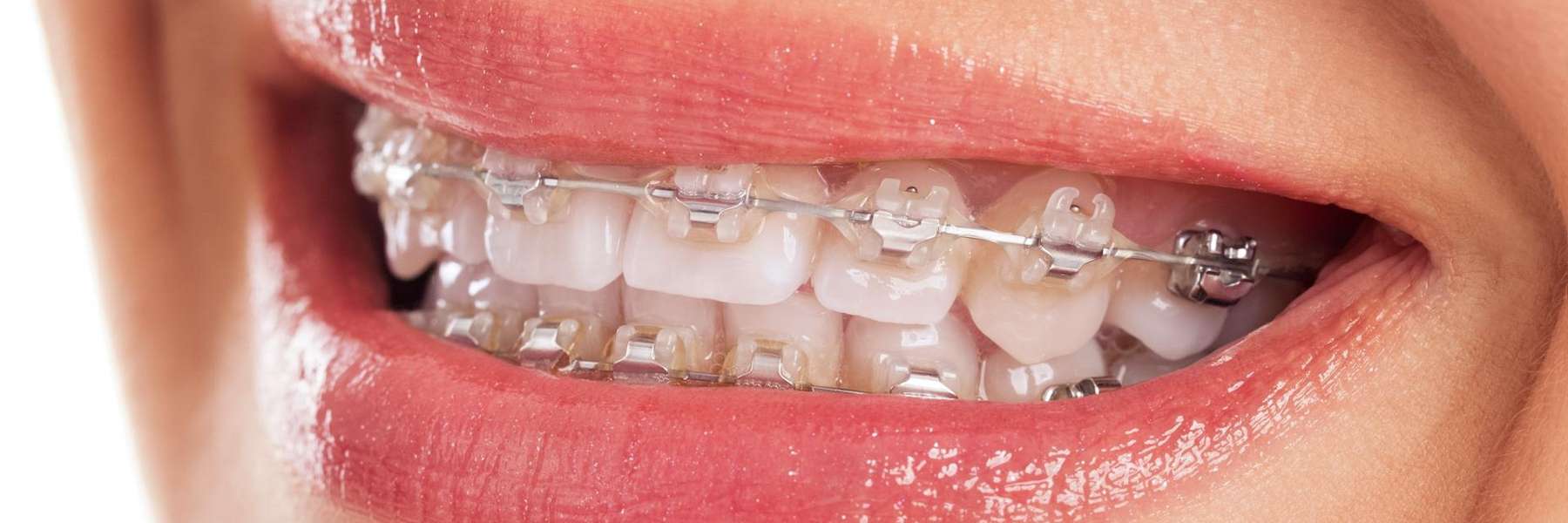 Braces
