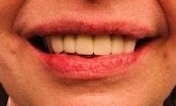 Photo of mouth after cosmetic bridge, charlotte nc