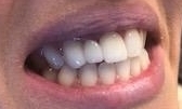 patient after implant and bridge | charlotte, nc