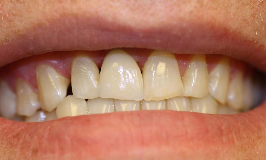 image of teeth after dental implant in Charlotte nc