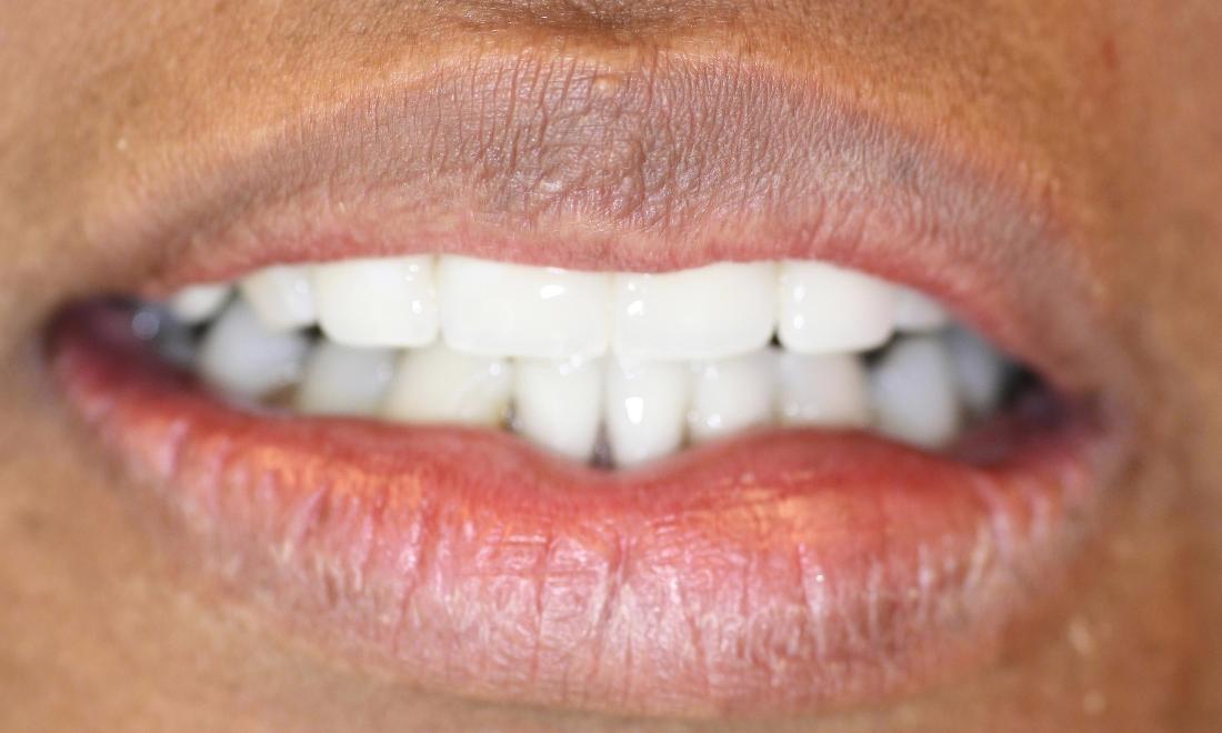 image of the same teeth after partial dentures Charlotte nc