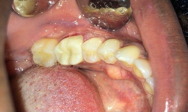 After picture of tooth with broken filling, charlotte nc
