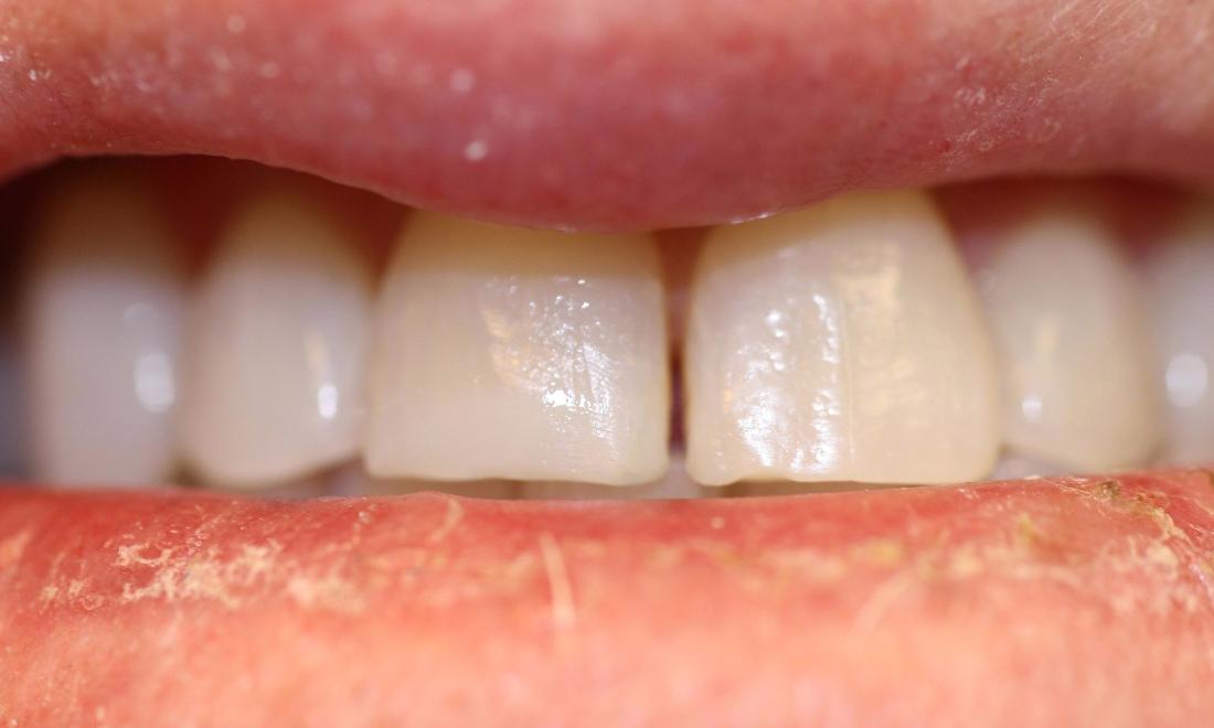 image of the same teeth after ZOOM! whitening in Charlotte nc