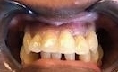 Close up of mouth before immediate denture, charlotte nc