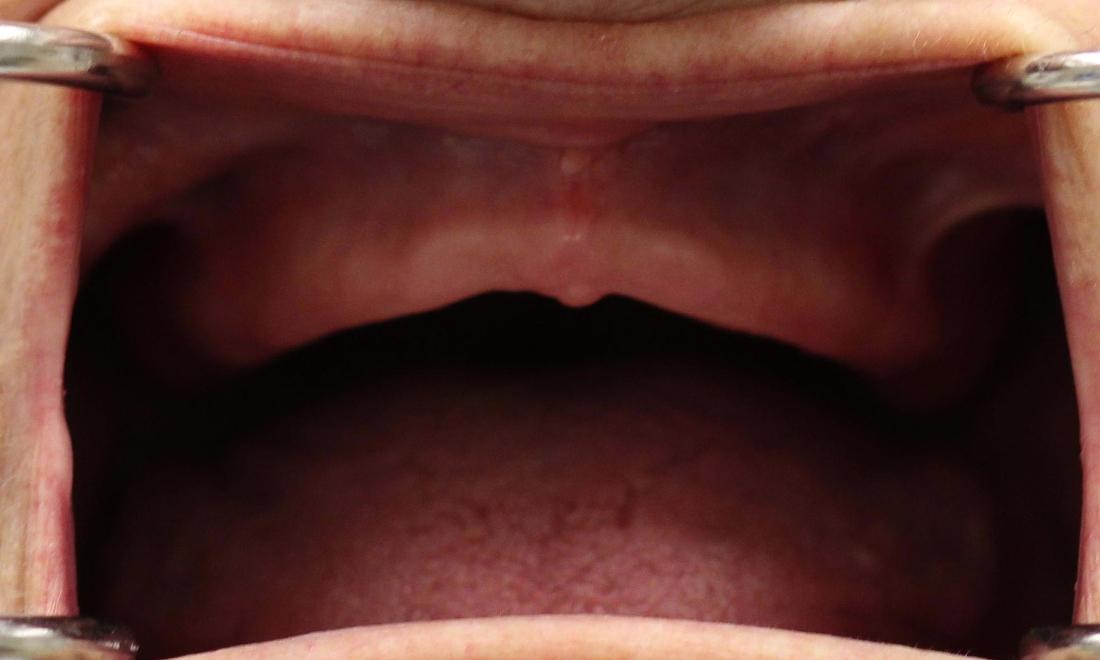 image of a patient before modern dentures Charlotte nc