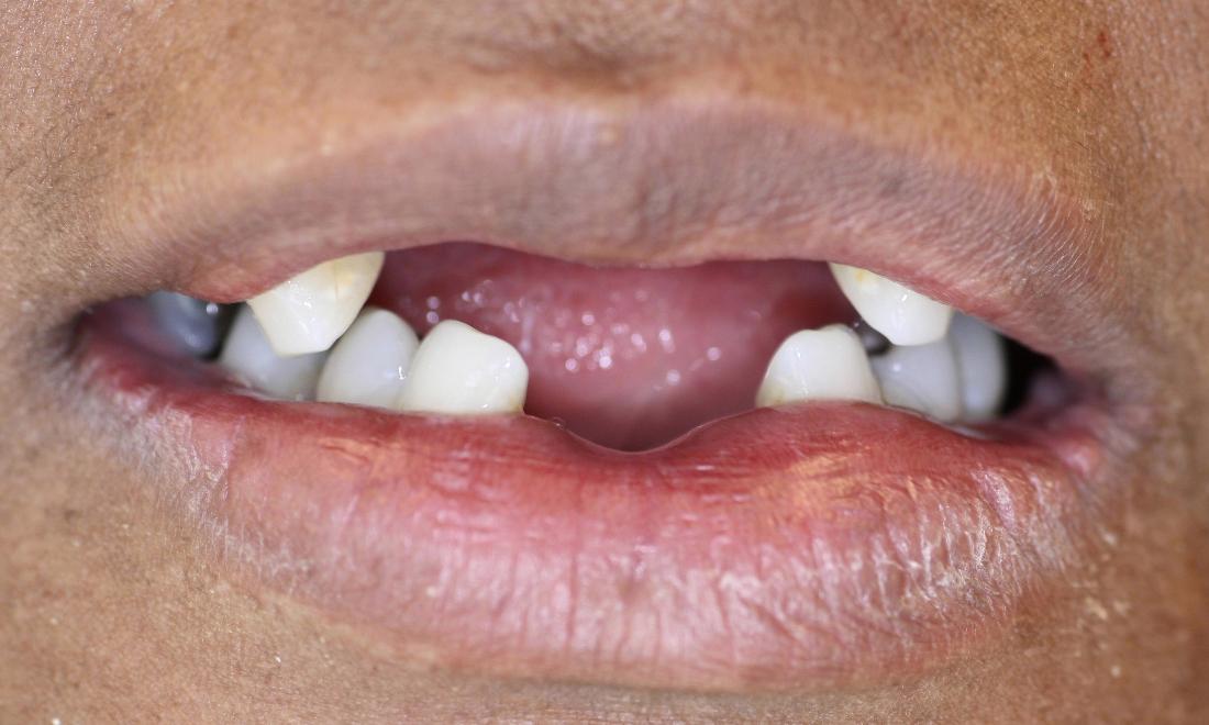 image of teeth before partial dentures Charlotte nc