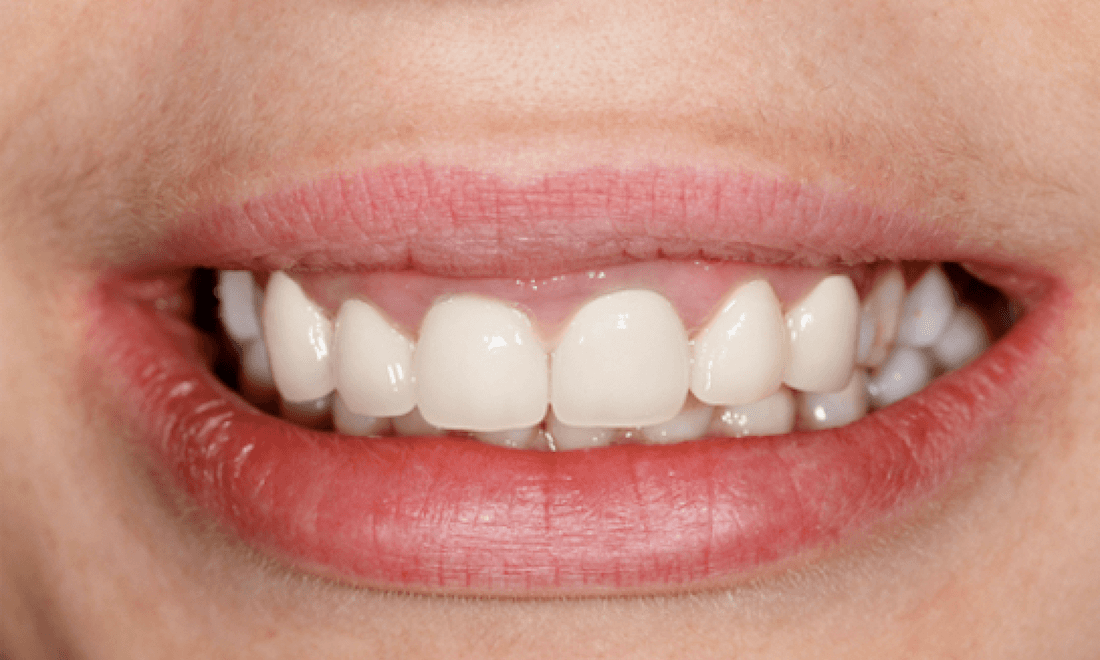Teeth after teeth whitening, charlotte nc