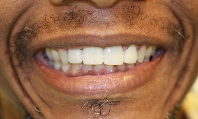 image of the same teeth after dental bridge in Charlotte nc