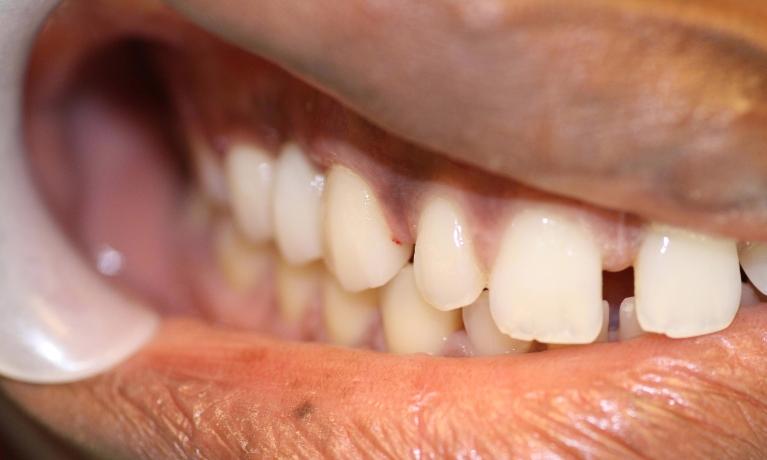 image of the same teeth after bridges in Charlotte nc