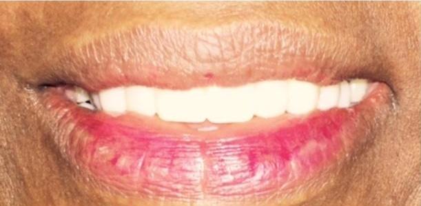 Cosmetic-Crowns-in-Charlotte-NC-After-Image