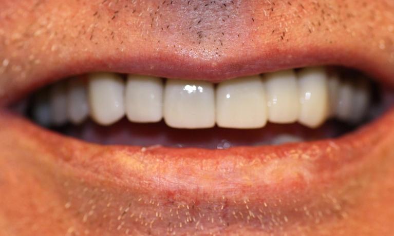image of the same teeth after cosmetic crowns in Charlotte nc
