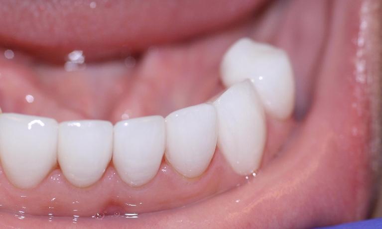 image of same teeth after cosmetic crowns Charlotte nc