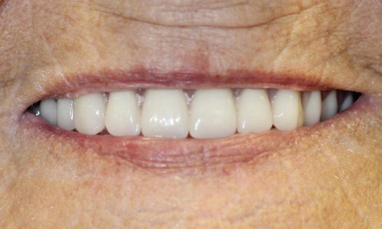 image of the same patient after modern dentures in Charlotte nc