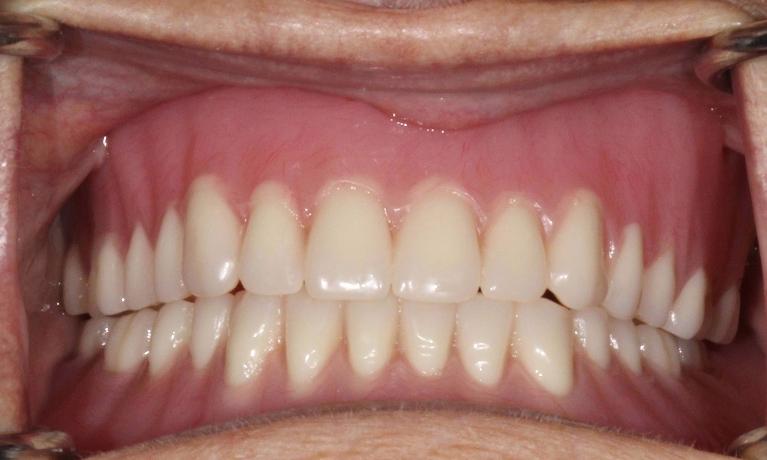 Dentures-in-Charlotte-NC-After-Image