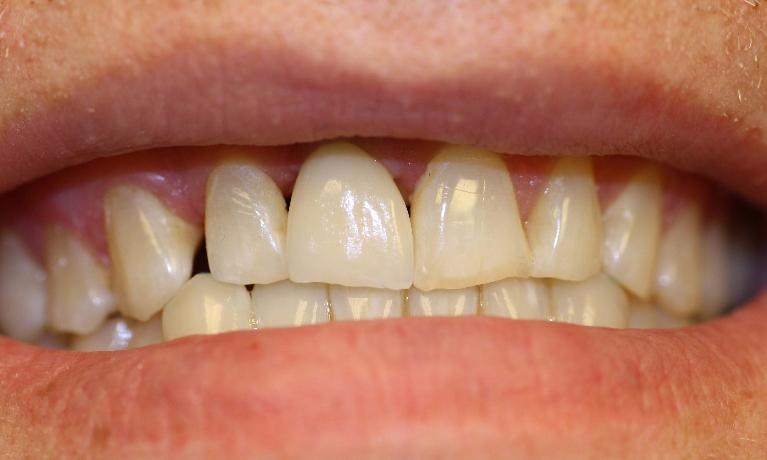 Dental-Implant-in-Charlotte-NC-After-Image