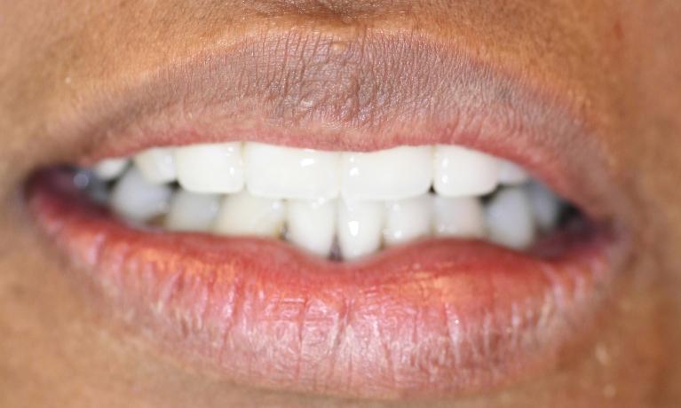 Partial-Denture-in-Charlotte-NC-After-Image