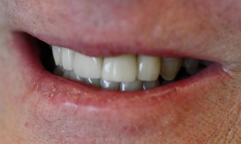 Veneers-in-Charlotte-NC-After-Image