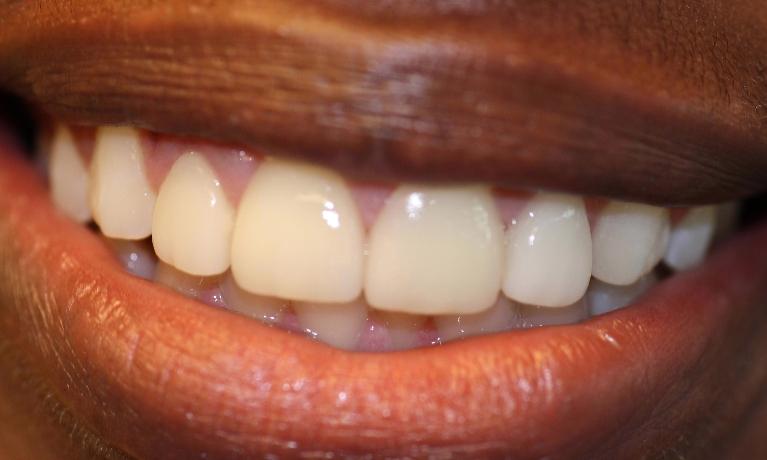 Veneers After | Fix Tooth Gap | Dentist in Charlotte