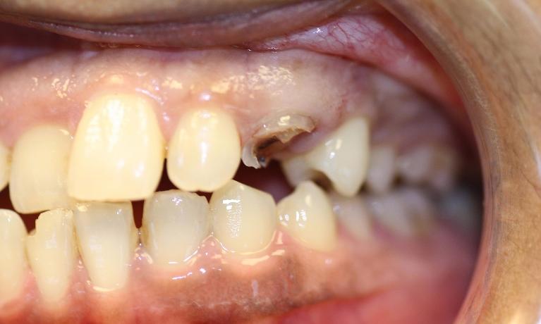 Bridge-with-Extraction-in-Charlotte-NC-Before-Image