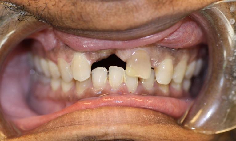image of teeth before dental bridges Charlotte nc