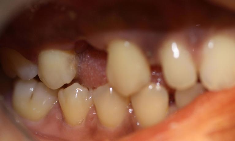 image of teeth before bridges in Charlotte nc