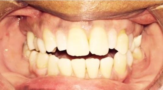 Cosmetic-Crowns-in-Charlotte-NC-Before-Image