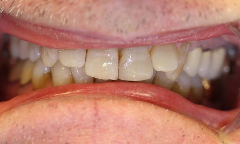 image of teeth before cosmetic crowns in Charlotte nc