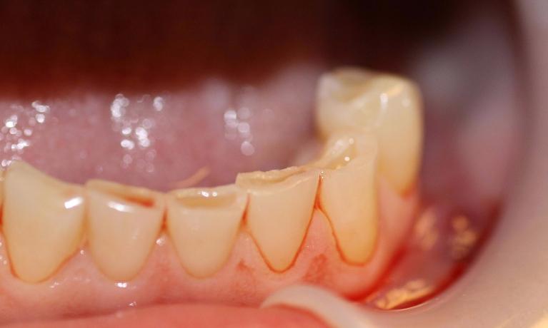 image of teeth before cosmetic crowns Charlotte nc