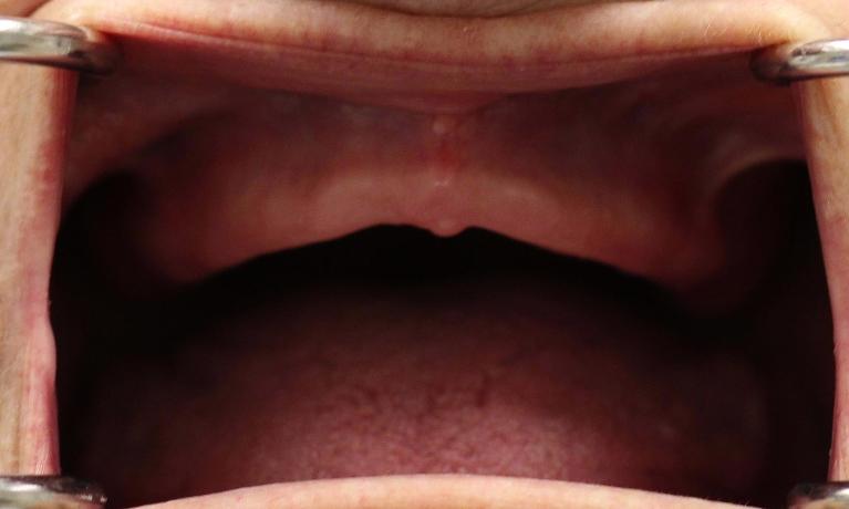 image of a patient before modern dentures Charlotte nc