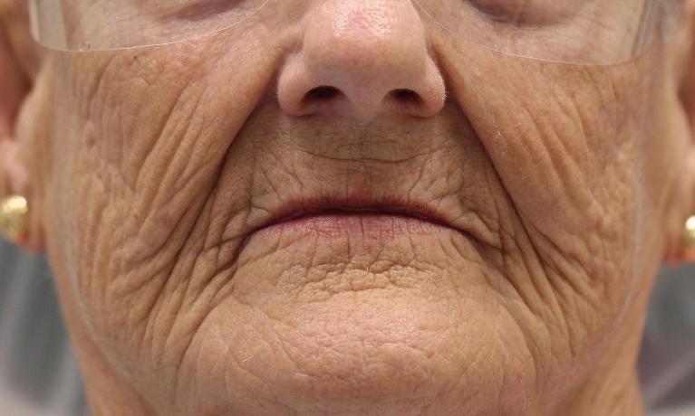 Dentures-in-Charlotte-NC-Before-Image