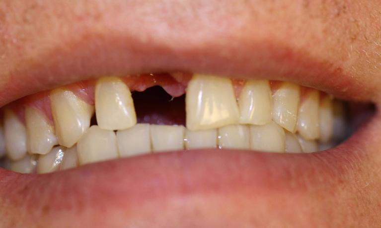 Dental-Implant-in-Charlotte-NC-Before-Image