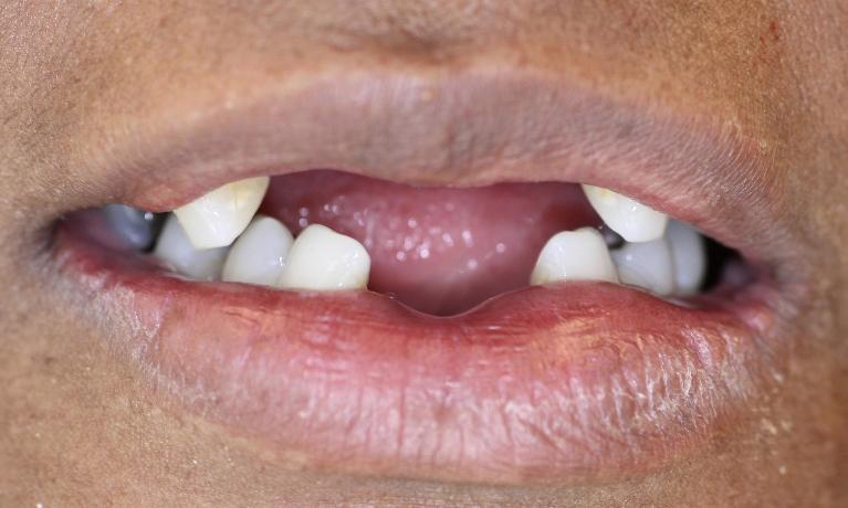 Partial-Denture-in-Charlotte-NC-Before-Image