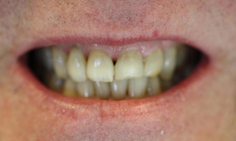 Veneers-in-Charlotte-NC-Before-Image