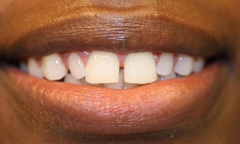 Veneers Before | Dentist Charlotte