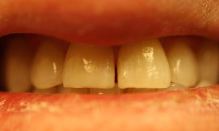 ZOOM-Whitening-in-Charlotte-NC-Before-Image