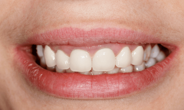 ZOOM-Whitening-in-Charlotte-NC-After-Image
