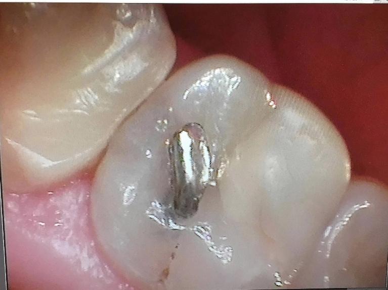 Intraoral camera photo of silver filling | Charlotte NC Dentist